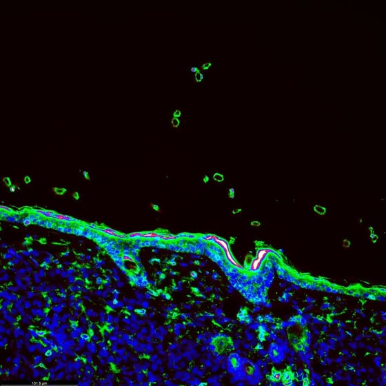5624_Tumour immunofluorescence IHC image of immunotherapy treatment